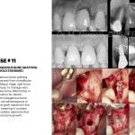 IMPrESS Perio Implant Center Dr. Noroozi Vancouver Periodontist Implant Specialist Burnaby BC