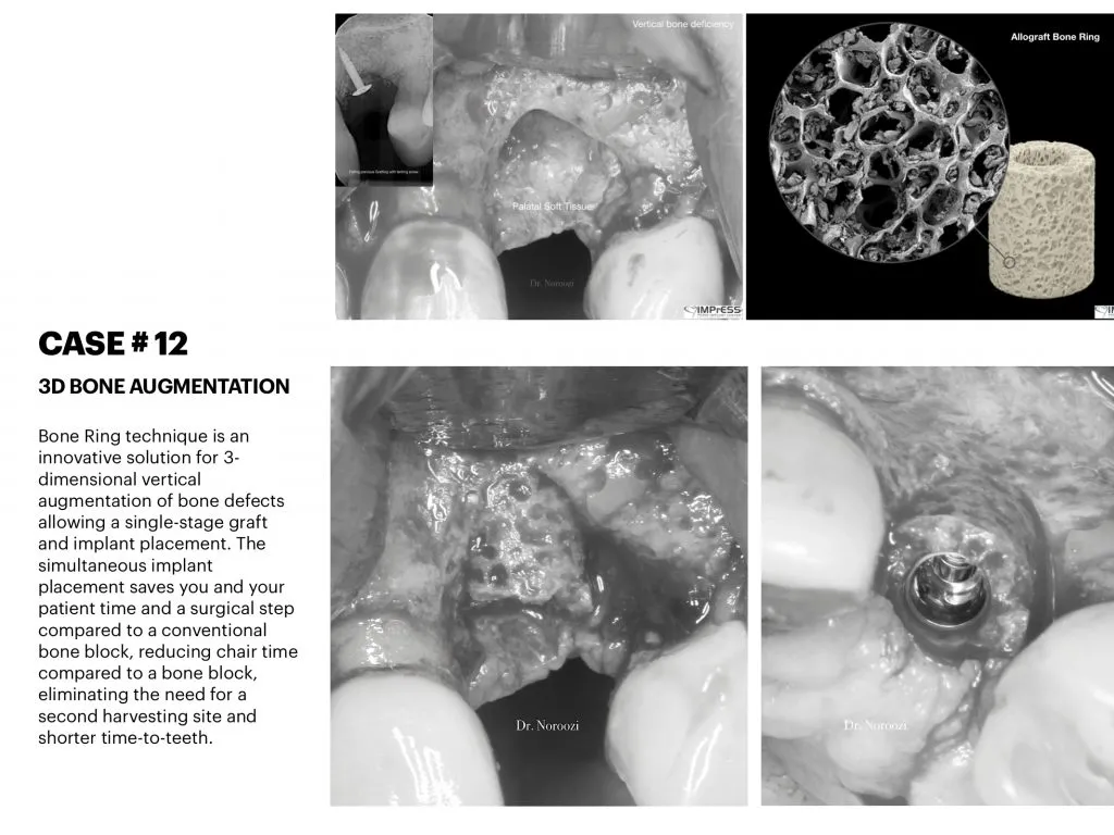 IMPrESS Perio Implant Center Dr. Noroozi Vancouver Periodontist Implant Specialist Burnaby BC