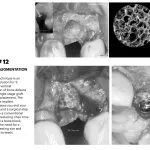IMPrESS Perio Implant Center Dr. Noroozi Vancouver Periodontist Implant Specialist Burnaby BC