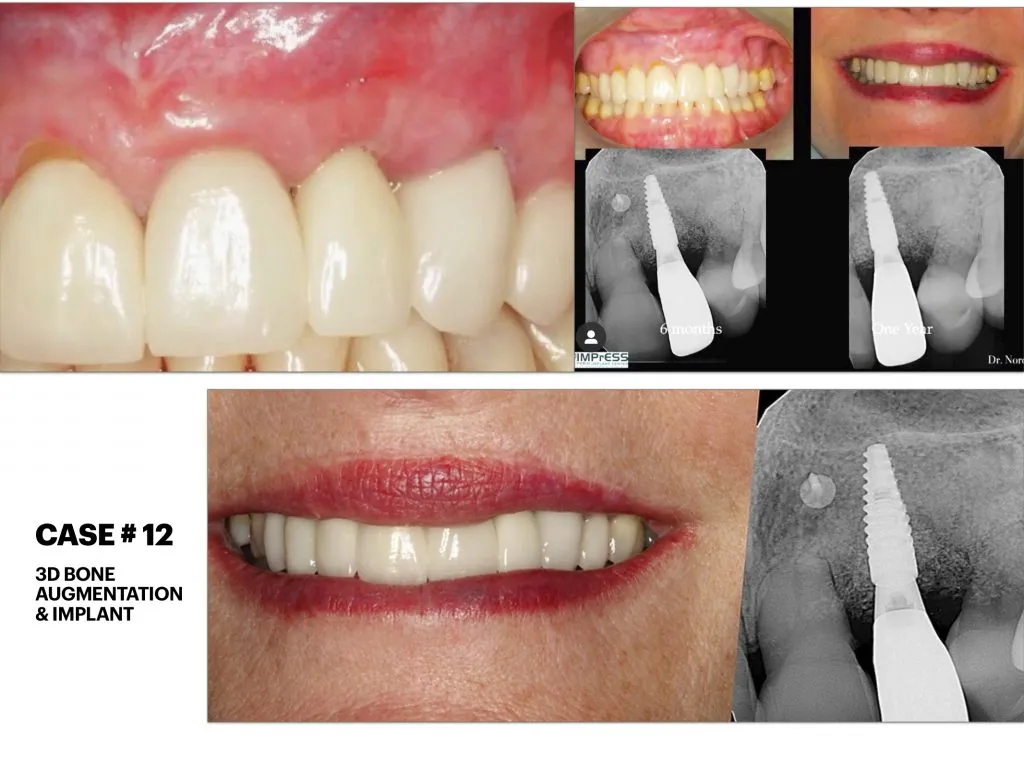 IMPrESS Perio Implant Center Dr. Noroozi Vancouver Periodontist Implant Specialist Burnaby BC