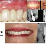 IMPrESS Perio Implant Center Dr. Noroozi Vancouver Periodontist Implant Specialist Burnaby BC