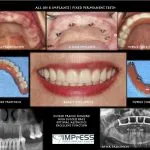 IMPrESS Perio Implant Center Dr. Noroozi Vancouver Periodontist Implant Specialist Burnaby BC