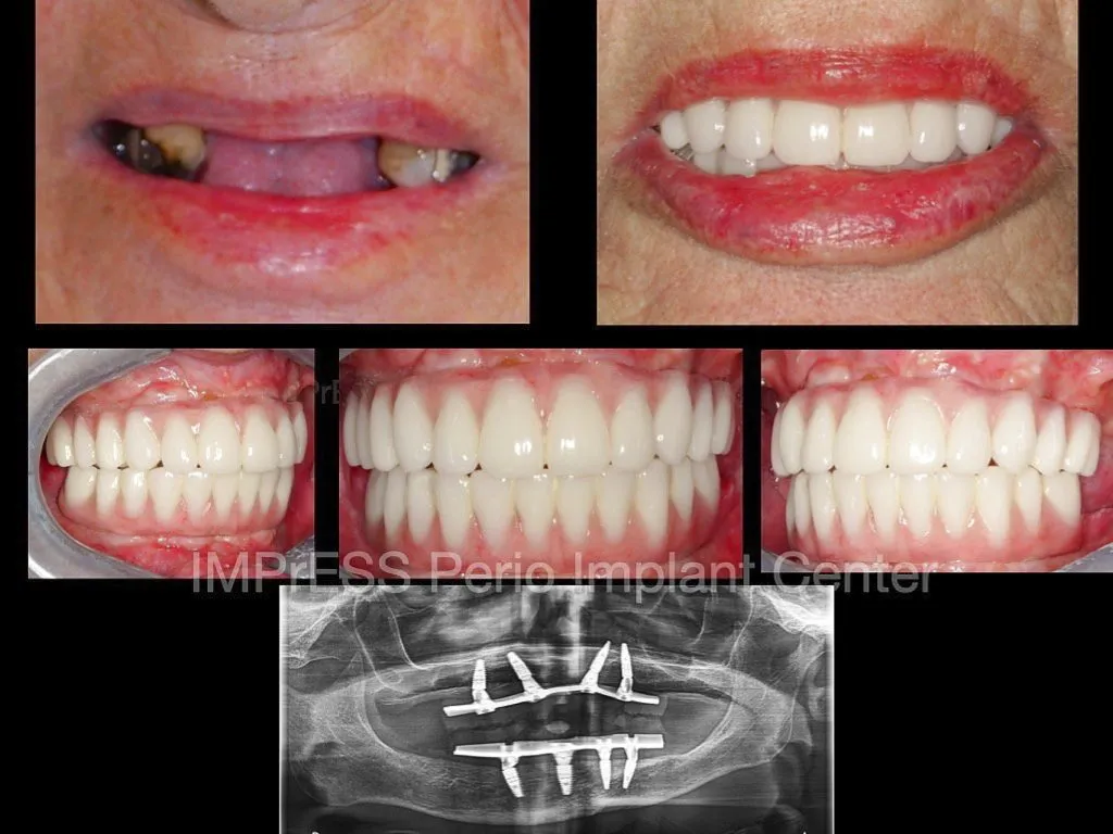 IMPrESS Perio Implant Center Dr. Noroozi Vancouver Periodontist Implant Specialist Burnaby BC
