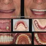 IMPrESS Perio Implant Center Dr. Noroozi Vancouver Periodontist Implant Specialist Burnaby BC