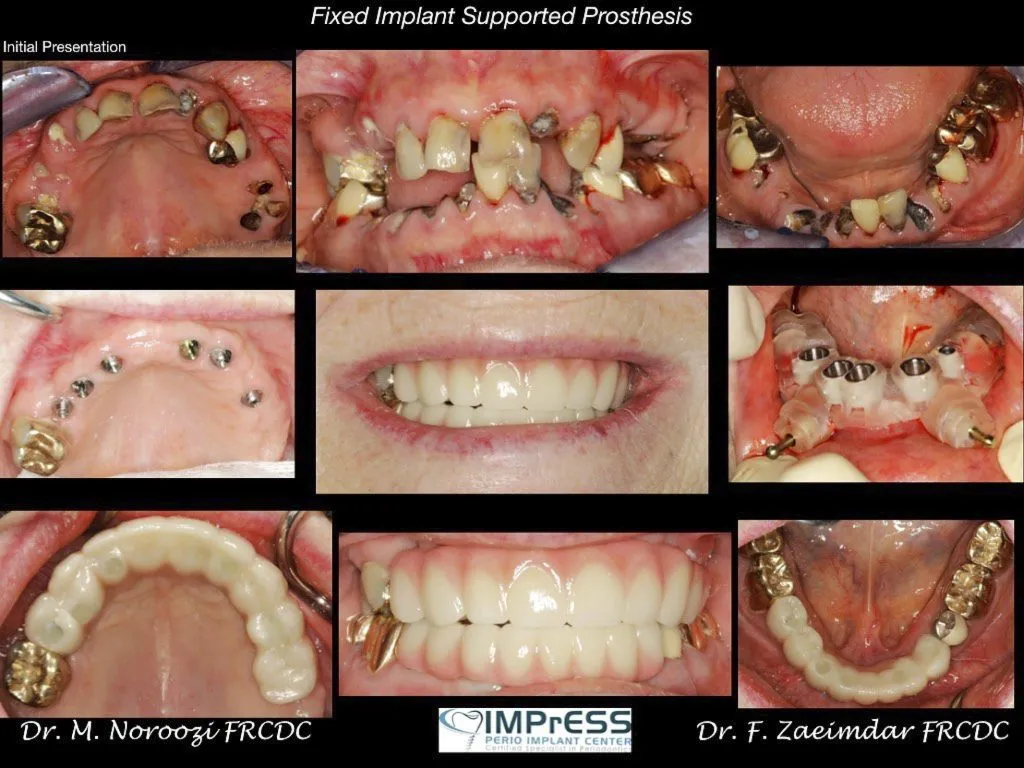 IMPrESS Perio Implant Center Dr. Noroozi Vancouver Periodontist Implant Specialist Burnaby BC