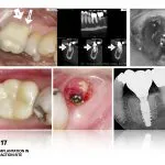 IMPrESS Perio Implant Center Dr. Noroozi Vancouver Periodontist Implant Specialist Burnaby BC