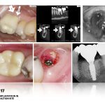 Dr. Noroozi IMPrESS Perio Implant Center Vancouver and Burnaby Advanced Centre for Periodontics and Implant Dentistry