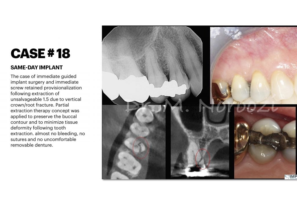 IMPrESS Perio Implant Center Dr. Noroozi Vancouver Periodontist Implant Specialist Burnaby BC