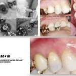 Dr. Noroozi IMPrESS Perio Implant Center Vancouver and Burnaby Advanced Centre for Periodontics and Implant Dentistry