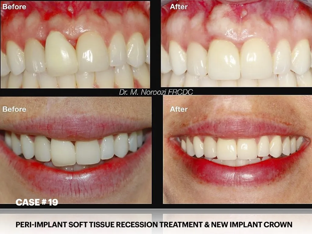 IMPrESS Perio Implant Center Dr. Noroozi Vancouver Periodontist Implant Specialist Burnaby BC
