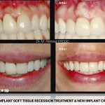 IMPrESS Perio Implant Center Dr. Noroozi Vancouver Periodontist Implant Specialist Burnaby BC