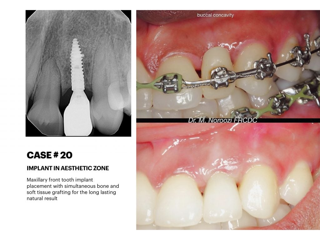 IMPrESS Perio Implant Center Dr. Noroozi Vancouver Periodontist Implant Specialist Burnaby BC