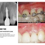 IMPrESS Perio Implant Center Dr. Noroozi Vancouver Periodontist Implant Specialist Burnaby BC