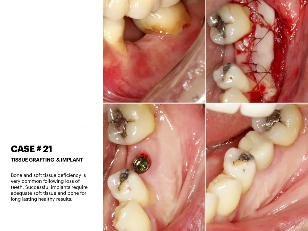 IMPrESS Perio Implant Center Dr. Noroozi Vancouver Periodontist Implant Specialist Burnaby BC