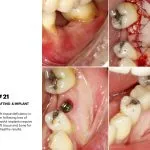 IMPrESS Perio Implant Center Dr. Noroozi Vancouver Periodontist Implant Specialist Burnaby BC