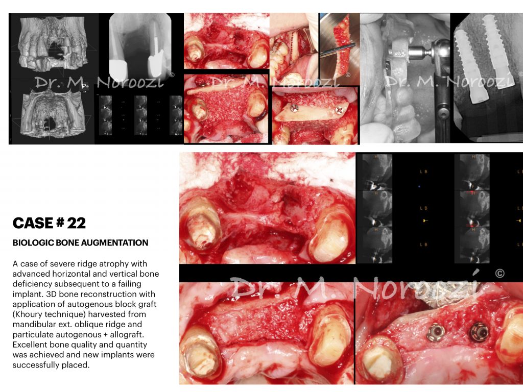 IMPrESS Perio Implant Center Dr. Noroozi Vancouver Periodontist Implant Specialist Burnaby BC