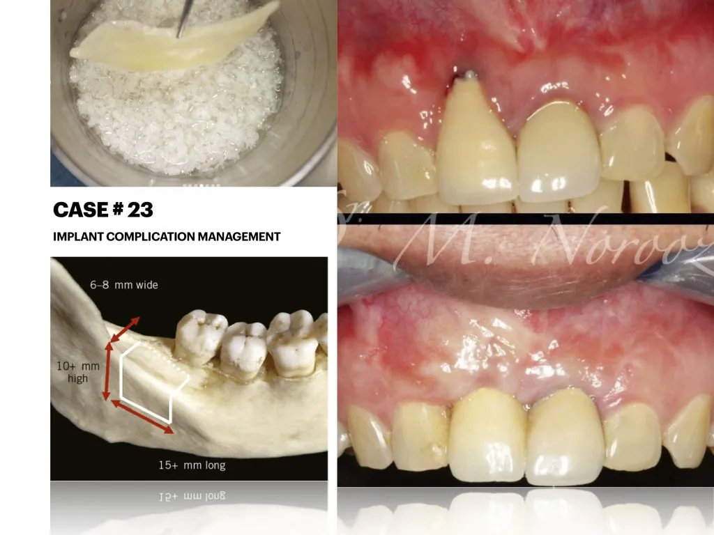 IMPrESS Perio Implant Center Dr. Noroozi Vancouver Periodontist Implant Specialist Burnaby BC