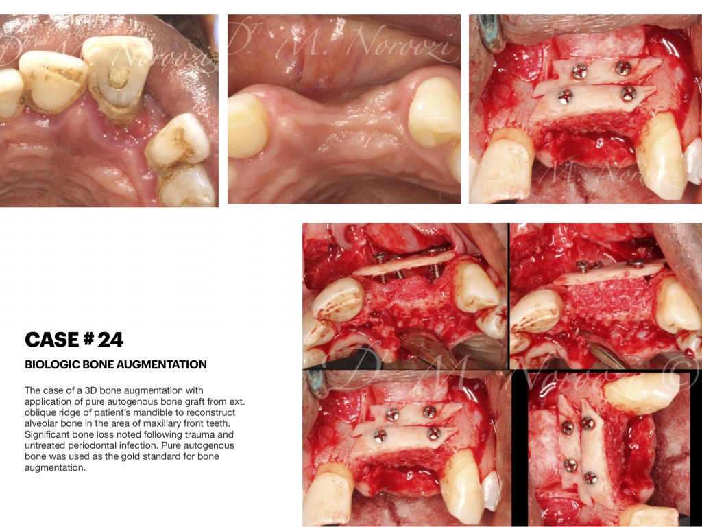 IMPrESS Perio Implant Center Dr. Noroozi Vancouver Periodontist Implant Specialist Burnaby BC