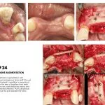 IMPrESS Perio Implant Center Dr. Noroozi Vancouver Periodontist Implant Specialist Burnaby BC