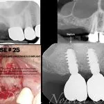 IMPrESS Perio Implant Center Dr. Noroozi Vancouver Periodontist Implant Specialist Burnaby BC
