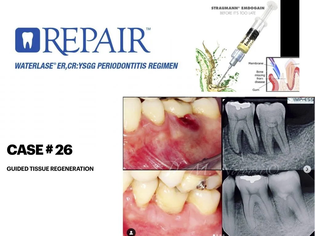 IMPrESS Perio Implant Center Dr. Noroozi Vancouver Periodontist Implant Specialist Burnaby BC