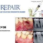 IMPrESS Perio Implant Center Dr. Noroozi Vancouver Periodontist Implant Specialist Burnaby BC