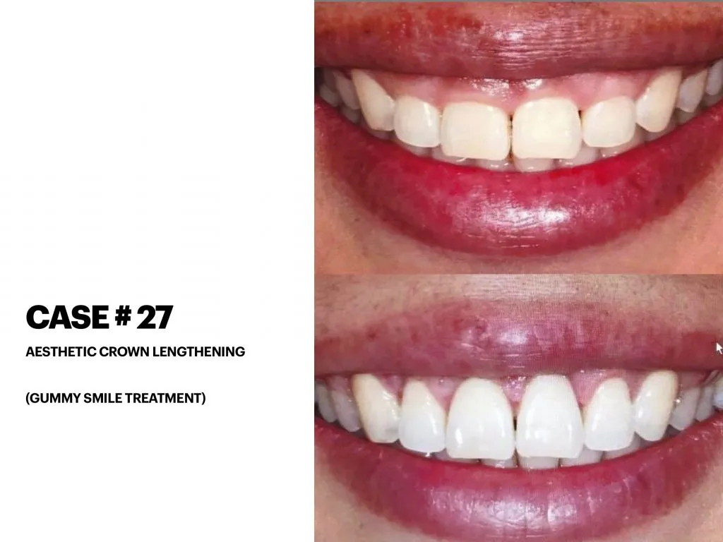 IMPrESS Perio Implant Center Dr. Noroozi Vancouver Periodontist Implant Specialist Burnaby BC