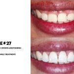 IMPrESS Perio Implant Center Dr. Noroozi Vancouver Periodontist Implant Specialist Burnaby BC