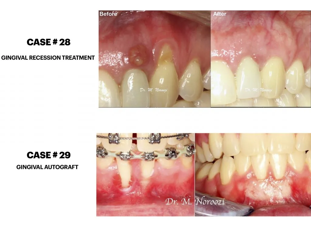 IMPrESS Perio Implant Center Dr. Noroozi Vancouver Periodontist Implant Specialist Burnaby BC