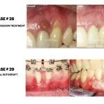 IMPrESS Perio Implant Center Dr. Noroozi Vancouver Periodontist Implant Specialist Burnaby BC