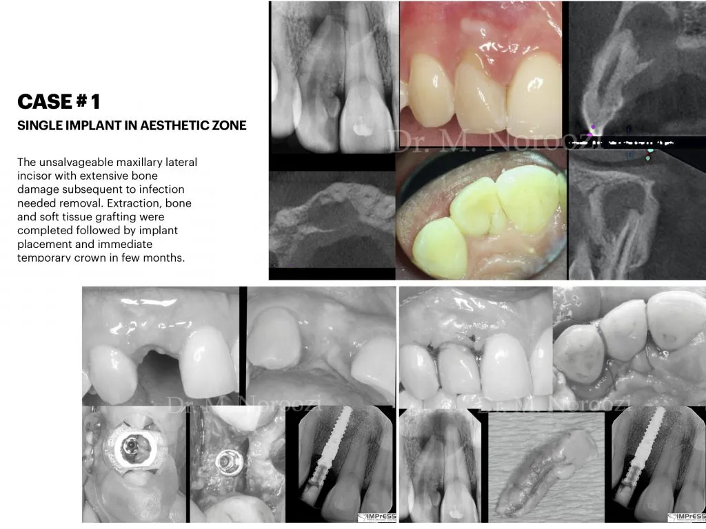 IMPrESS Perio Implant Center Dr. Noroozi Vancouver Periodontist Implant Specialist Burnaby BC