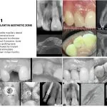 IMPrESS Perio Implant Center Dr. Noroozi Vancouver Periodontist Implant Specialist Burnaby BC