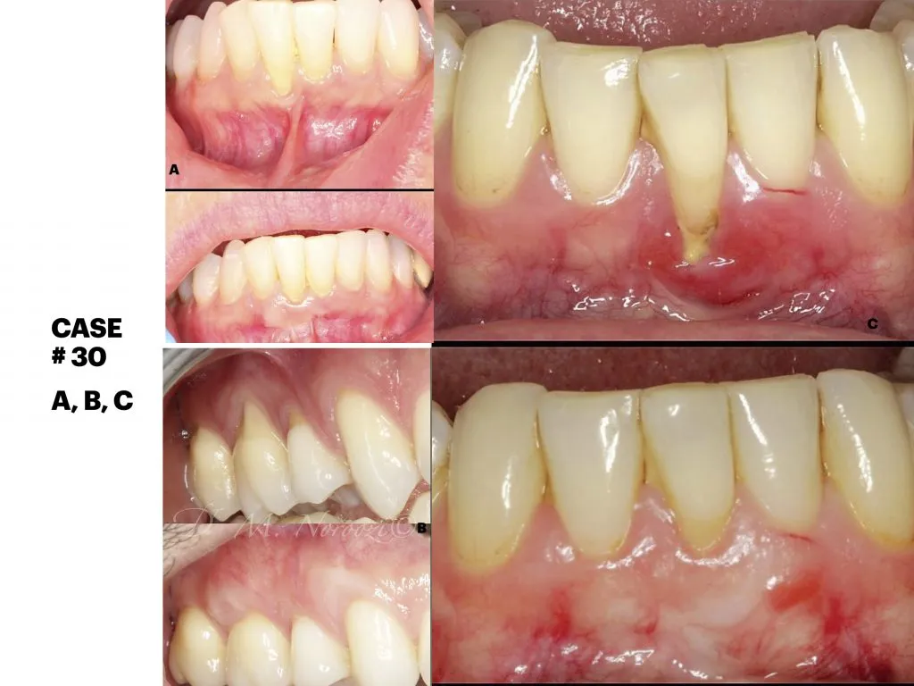 IMPrESS Perio Implant Center Dr. Noroozi Vancouver Periodontist Implant Specialist Burnaby BC