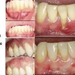 IMPrESS Perio Implant Center Dr. Noroozi Vancouver Periodontist Implant Specialist Burnaby BC