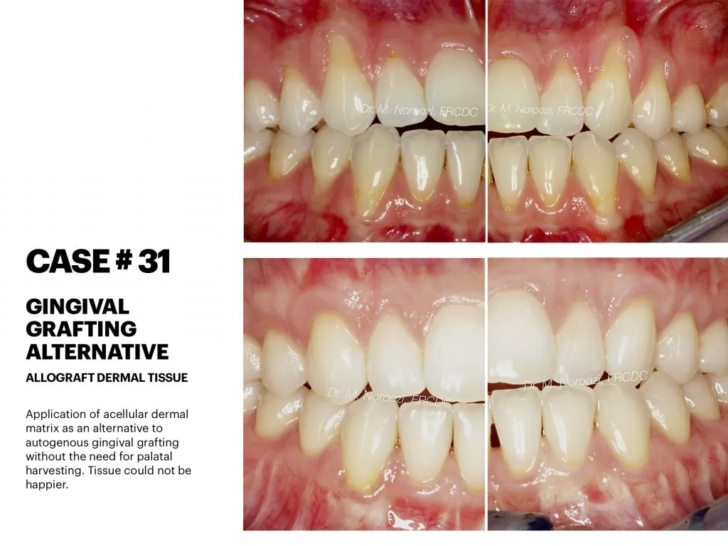 IMPrESS Perio Implant Center Dr. Noroozi Vancouver Periodontist Implant Specialist Burnaby BC