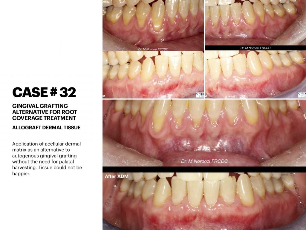 IMPrESS Perio Implant Center Dr. Noroozi Vancouver Periodontist Implant Specialist Burnaby BC