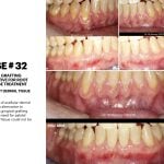IMPrESS Perio Implant Center Dr. Noroozi Vancouver Periodontist Implant Specialist Burnaby BC