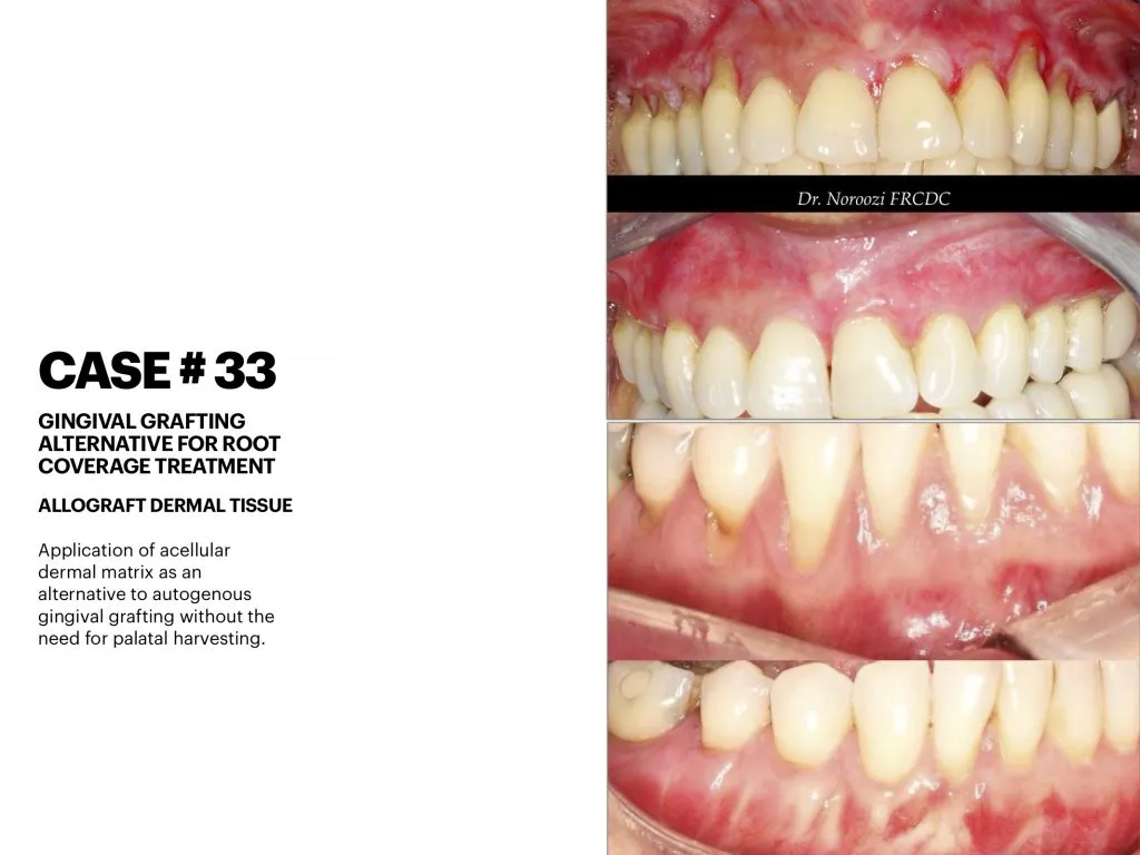 IMPrESS Perio Implant Center Dr. Noroozi Vancouver Periodontist Implant Specialist Burnaby BC