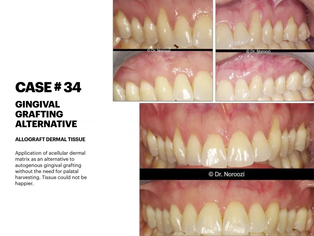 IMPrESS Perio Implant Center Dr. Noroozi Vancouver Periodontist Implant Specialist Burnaby BC