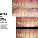 IMPrESS Perio Implant Center Dr. Noroozi Vancouver Periodontist Implant Specialist Burnaby BC