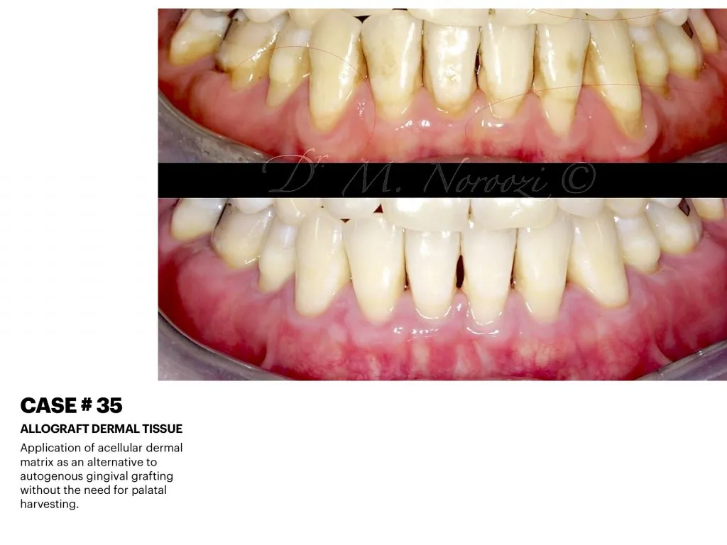 IMPrESS Perio Implant Center Dr. Noroozi Vancouver Periodontist Implant Specialist Burnaby BC