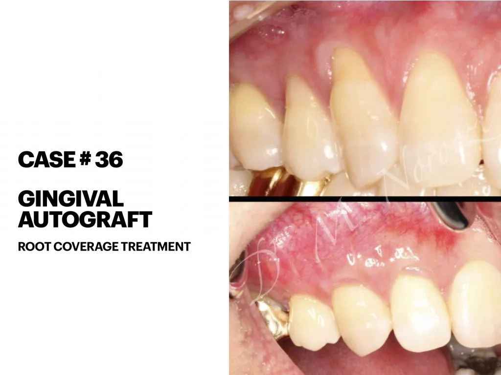 IMPrESS Perio Implant Center Dr. Noroozi Vancouver Periodontist Implant Specialist Burnaby BC