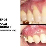 IMPrESS Perio Implant Center Dr. Noroozi Vancouver Periodontist Implant Specialist Burnaby BC