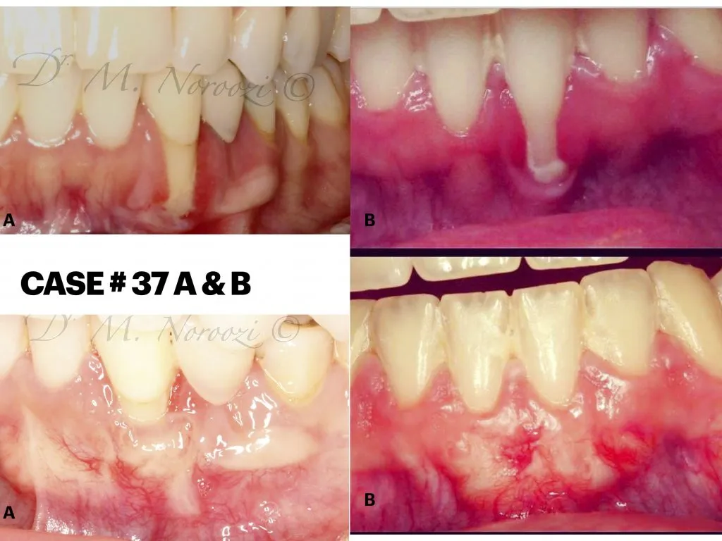 IMPrESS Perio Implant Center Dr. Noroozi Vancouver Periodontist Implant Specialist Burnaby BC