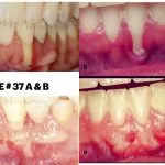 IMPrESS Perio Implant Center Dr. Noroozi Vancouver Periodontist Implant Specialist Burnaby BC