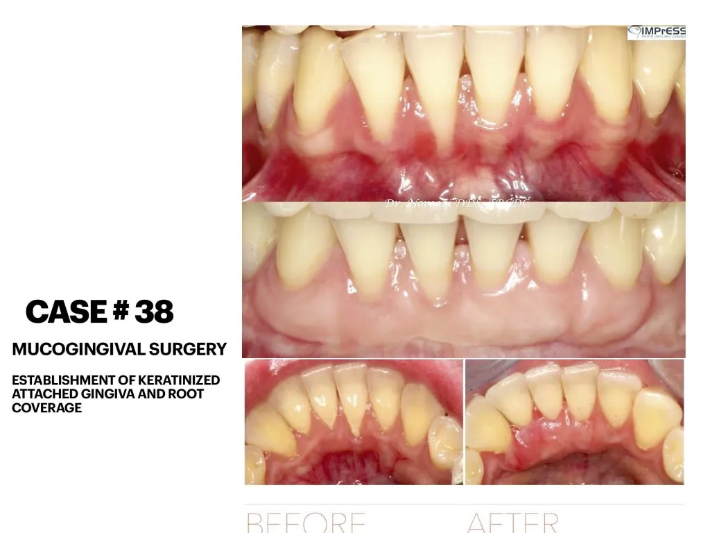 IMPrESS Perio Implant Center Clinical Cases Dr. Noroozi Certified Specialist in Periodontics Implant Dentistry Vancouver Burnaby BC