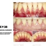 IMPrESS Perio Implant Center Clinical Cases Dr. Noroozi Certified Specialist in Periodontics Implant Dentistry Vancouver Burnaby BC