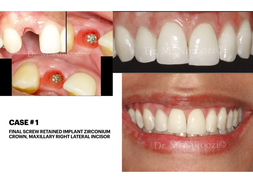 Front Implant tooth Best Implant Dentist Vancouver Burnaby BC Best Implant CenterIMPrESS Perio Implant Center Dr. Noroozi Vancouver Periodontist Implant Specialist Burnaby BC