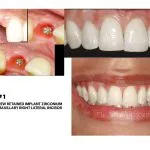 Front Implant tooth Best Implant Dentist Vancouver Burnaby BC Best Implant CenterIMPrESS Perio Implant Center Dr. Noroozi Vancouver Periodontist Implant Specialist Burnaby BC