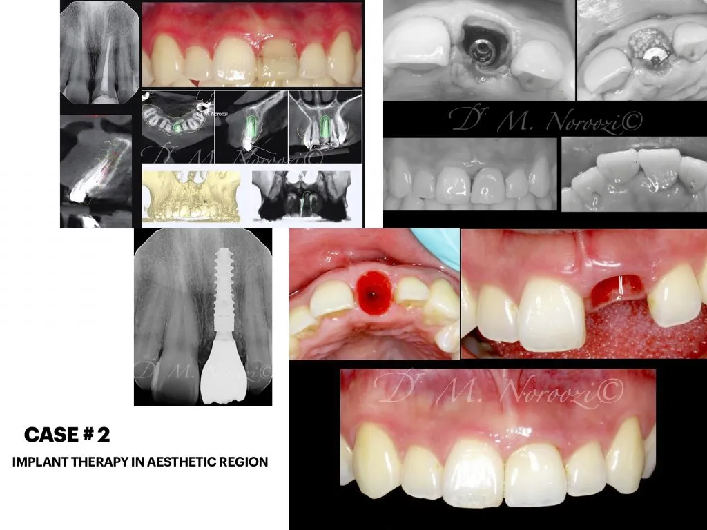 IMPrESS Perio Implant Center Dr. Noroozi Vancouver Periodontist Implant Specialist Burnaby BC